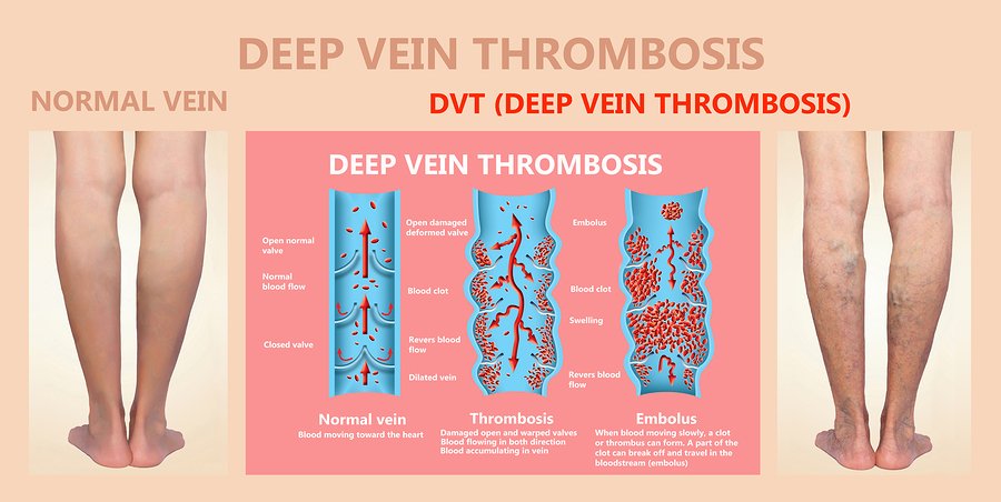 How Do You Know If You Have Deep Vein Thrombosis Dvt - vrogue.co